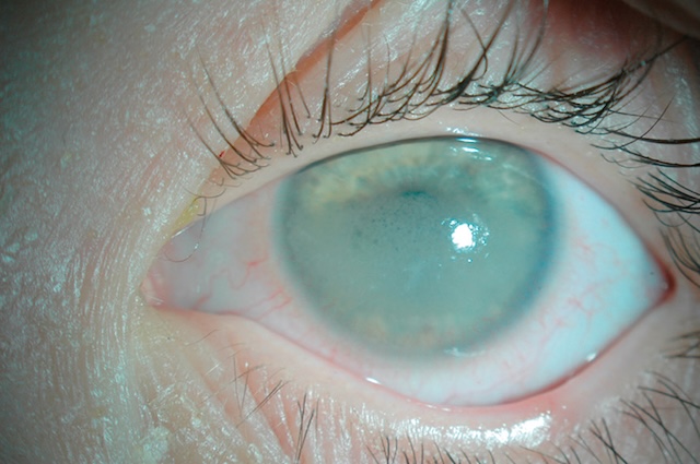 Kératopathie en bandelette avec opacité cornéenne centrale dans une uvéite chronique liée à l’arthrite juvénile idiopathique. Dépôts calciques typiques visibles.