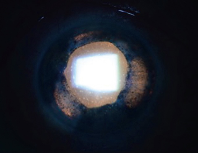 Zones d’atrophie irienne visibles en rétro-illumination, liées à une uvéite herpétique récidivante.