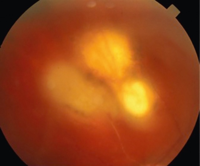 Fond d’œil montrant récidive de toxoplasmose oculaire active avec foyer nécrotique et occlusion de branche artérielle rétinienne.