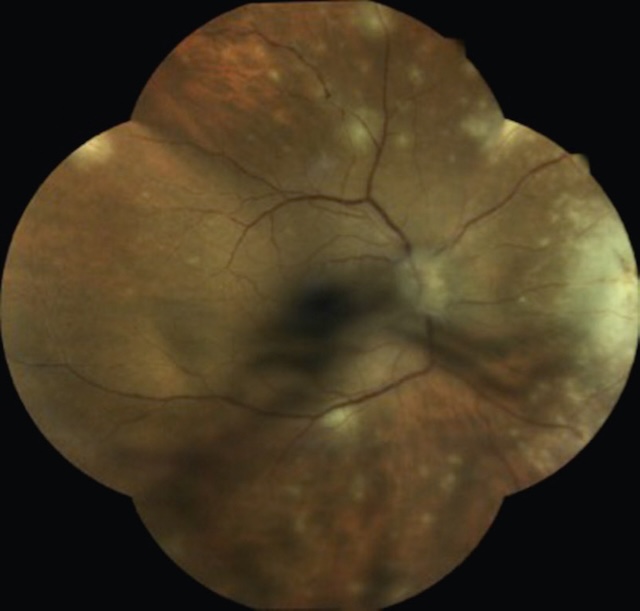 Fond d’œil droit montrant une nécrose rétinienne aiguë herpétique active, avec atteinte maculaire, urgence ophtalmologique menaçant la vision.