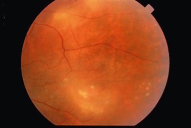 Foyers blanchâtres en périphérie rétinienne caractéristiques d’une rétinite syphilitique active.