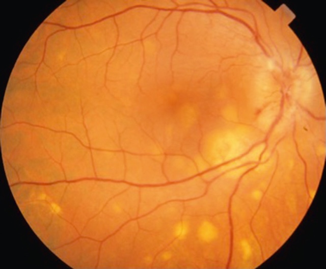 Foyers granulomateux diffus et bord flou du nerf optique sur fond d’œil. Aspect compatible avec choroïdite et papillite sarcoïdosiques actives.