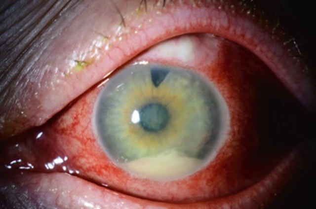 Œil inflammatoire avec hypopion et bulle infectée, complication tardive d’une chirurgie du glaucome par trabéculectomie.