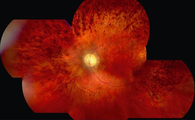 Rétinienne composite montrant une pâleur centrale du nerf optique et des migrations pigmentaires en périphérie dans une rétinopathie pigmentaire typique.