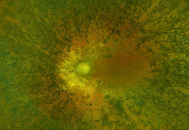 Fond d’œil montrant une rétinopathie pigmentaire typique avec atteinte des bâtonnets et migration pigmentaire périphérique en pseudo-ostéoblastes.