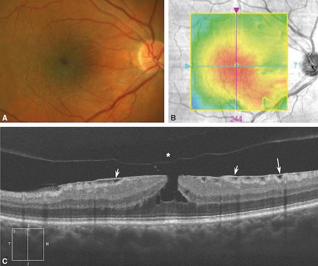 Fond d’œil, carte d’épaisseur et coupe OCT montrant une membrane épirétinienne avec traction maculaire et épaississement rétinien.