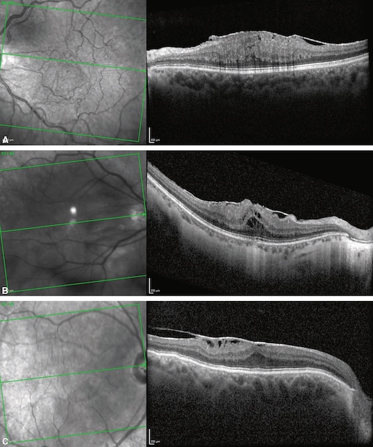 Trois vues OCT illustrant une membrane épimaculaire avec plis rétiniens et distorsion maculaire chez différents patients.