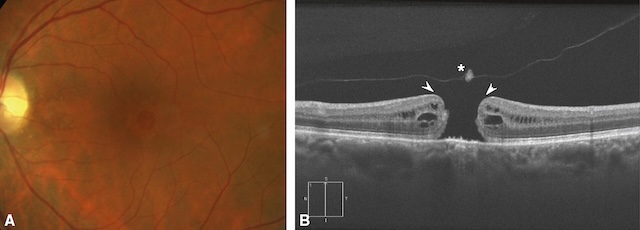 Image couleur du fond d’œil et tomographie en cohérence optique (OCT) montrant un trou maculaire.