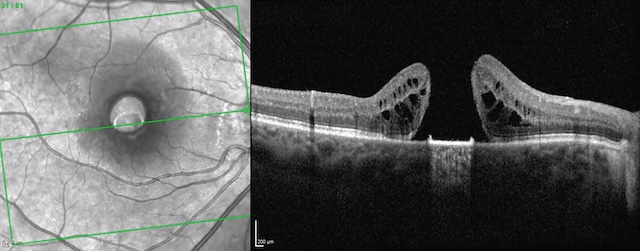 Trou maculaire visible en tomographie en cohérence optique avec perte de continuité fovéolaire.