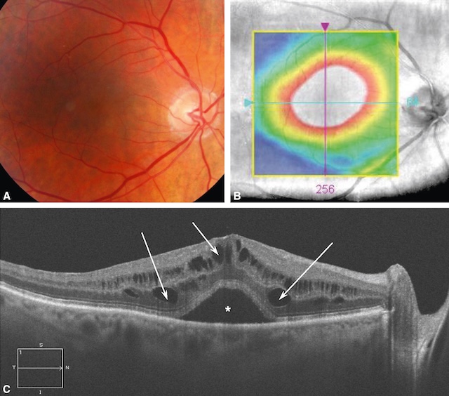Images multimodales d’un œdème maculaire diabétique montrant l’aspect clinique, la topographie et l’atteinte anatomique en OCT.