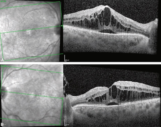 Image OCT montrant un œdème maculaire diabétique avec élévation de l'épaisseur rétinienne et présence de kystes intrarétiniens.