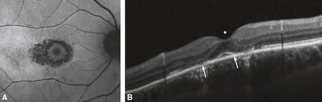 Imagerie d’une maculopathie toxique aux antipaludéens avec aspect en œil de bœuf et atteinte des couches rétiniennes.