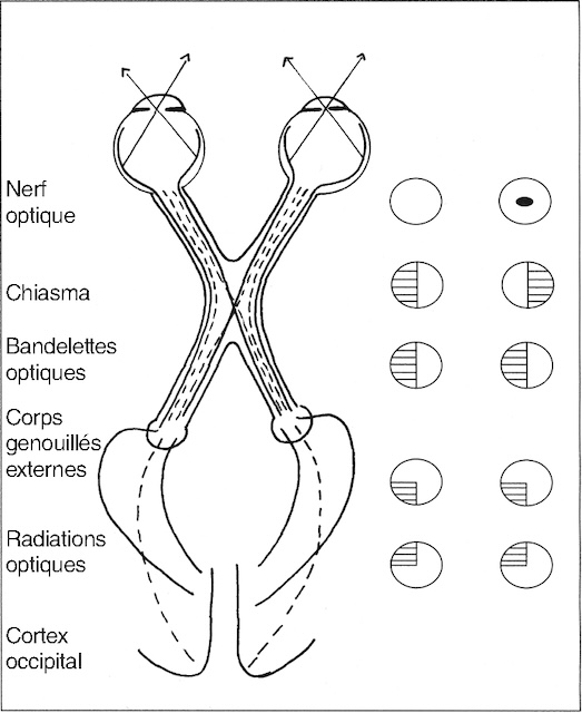Schéma du trajet des voies optiques et des altérations visuelles correspondantes selon le site de la lésion.
