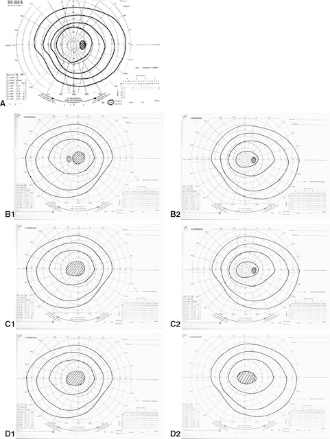 Résultats de périmétrie illustrant divers déficits du champ visuel liés à des atteintes du nerf optique, de la partie A à F2.