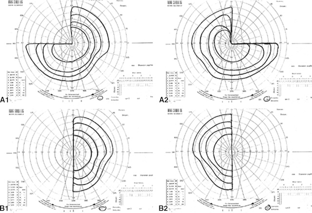 Périmétries montrant une quadranopsie bitemporale supérieure et une hémianopsie bitemporale complète, évoquant une atteinte partielle puis complète du chiasma optique.