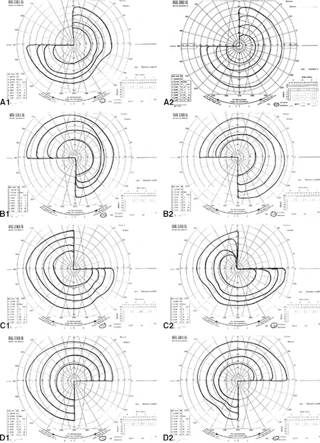 Périmétries montrant des quadranopsies latérales homonymes typiques d’atteintes rétrochiasmatiques.