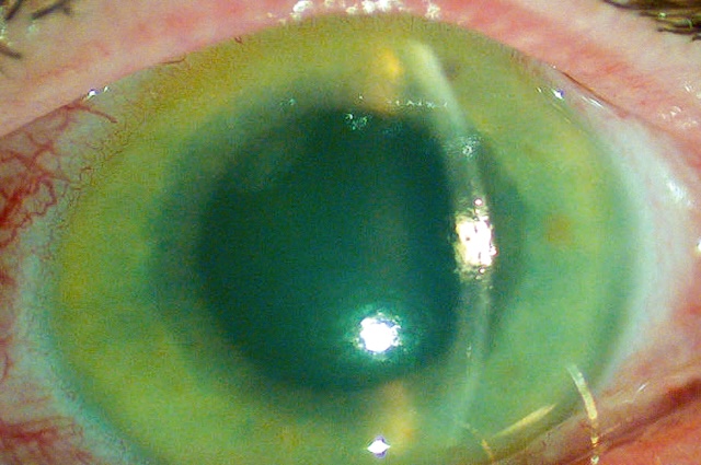 Aspect œdémateux de la cornée en crise aiguë de fermeture de l’angle, urgence glaucomateuse captée à la lampe à fente.