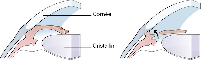 Blocage pupillaire supprimé par iridotomie laser, permettant le rétablissement du flux de l’humeur aqueuse.