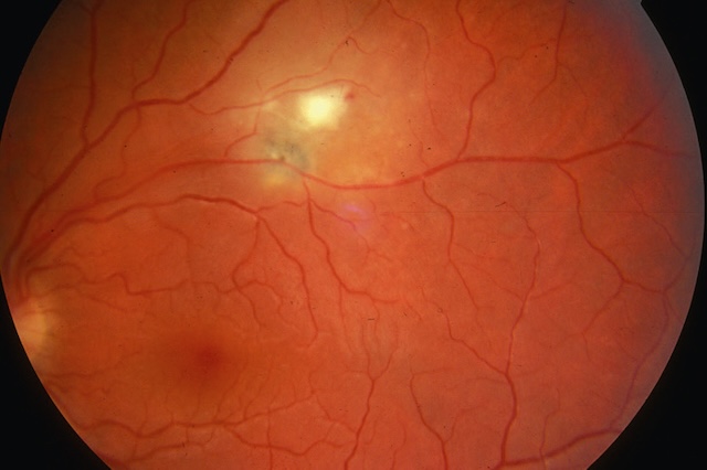 Foyer blanchâtre actif juxtaposé à une cicatrice pigmentée sur fond d’œil gauche. Présentation typique d’une choriorétinite toxoplasmique récurrente.