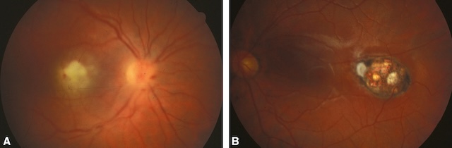 Un foyer toxoplasmique actif et une cicatrice ancienne illustrent deux temps d’une toxoplasmose oculaire bilatérale.