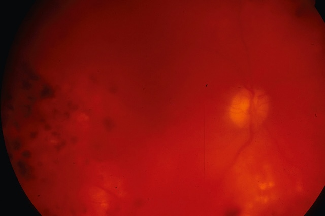 Rétinographie montrant un voile hémorragique diffus dans le vitré avec visualisation partielle du fond d’œil et foyers d’exsudats périphériques.