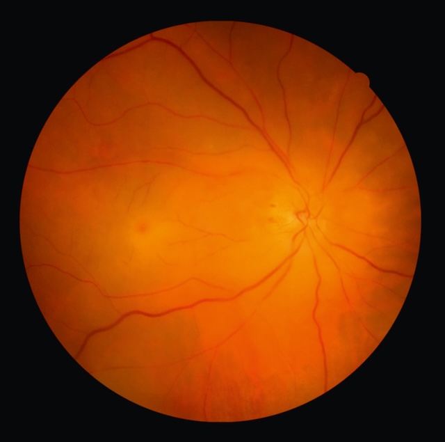 Fond d’œil d’une occlusion d’artère centrale rétinienne avec œdème blanchâtre et macula rouge cerise, image typique d’une urgence vasculaire rétinienne.