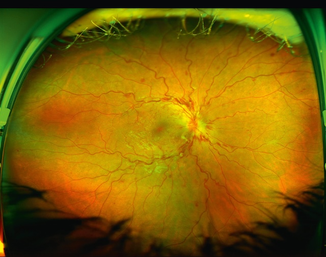 Occlusion de la veine centrale avec œdème papillaire, hémorragies diffuses et dilatation veineuse sur tout le fond d’œil.