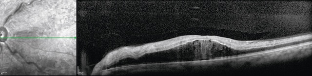 OCT de l’œil gauche révélant un œdème maculaire avec disparition de la fovéa. Présence de cavités intrarétiniennes compatibles avec un œdème cystoïde.