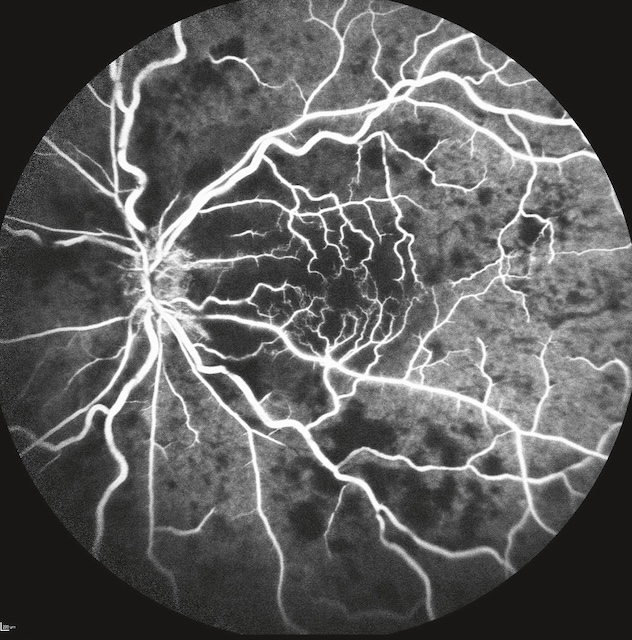 OVCR ischémique montrée par angiographie avec multiples zones de non-perfusion et vaisseaux dilatés.