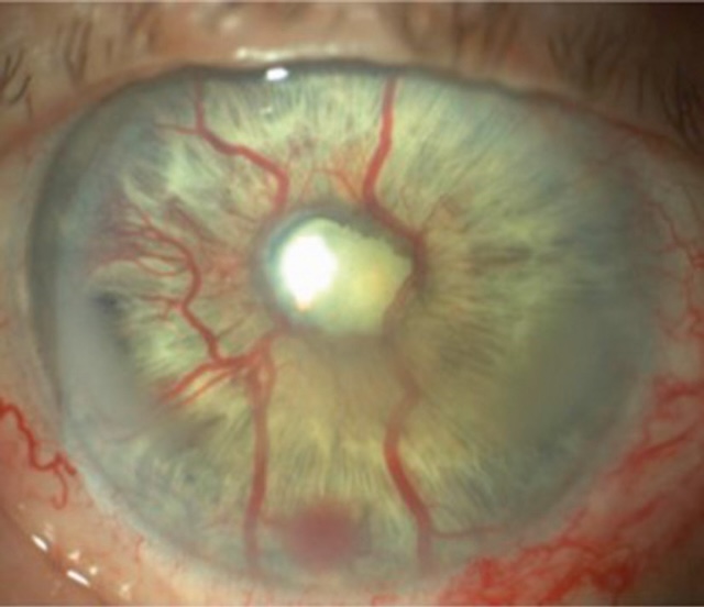 Image en lampe à fente montrant une rubéose irienne étendue avec néovaisseaux sur tout l’iris dans un contexte d’OVCR ischémique.