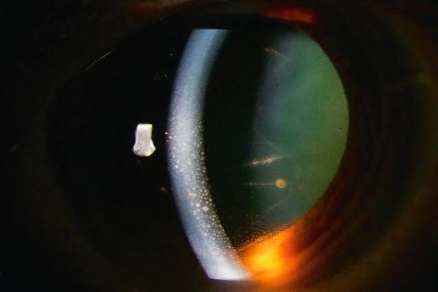 Précipités rétrocornéens blanchâtres observés à la lampe à fente, typiques d’une uvéite antérieure granulomateuse à expression inflammatoire chronique.