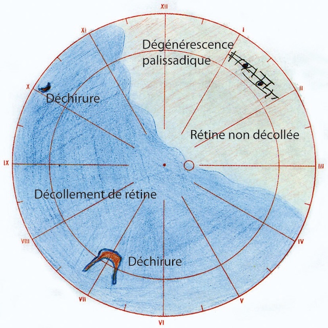 Carte schématique d’un décollement de rétine droit avec deux déchirures et zone de rétine encore attachée.