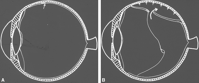 Schéma illustrant le mécanisme d’un décollement rétinien rhegmatogène. Déchirure initiale suivie d’un soulèvement progressif de la rétine neurosensorielle.