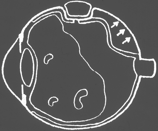 Schéma montrant le principe chirurgical de colmatage d’une déhiscence dans un décollement de rétine.