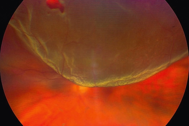 Rétinographie ultra grand champ montrant un décollement rétinien bulleux supérieur de l’œil gauche, lié à une déchirure située en région supérieure.