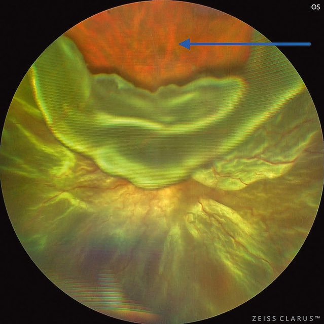 Décollement de rétine total avec déchirure large à 12h, rétine flottante capturée en imagerie ultra-grand champ de l’œil gauche.