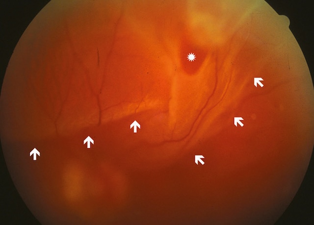 Fond d’œil montrant un décollement rétinien avec soulèvement temporal supérieur et déformation vasculaire marquée.