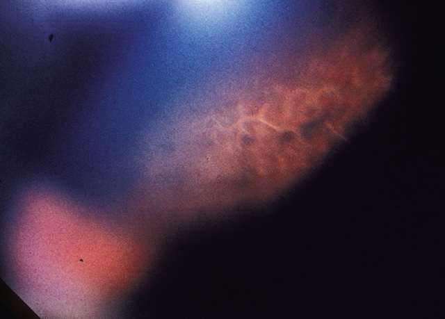 Aspect typique de dégénérescence palissadique en rétine périphérique. Zones linéaires pigmentées visibles à la lampe à fente, facteur de risque de décollement.