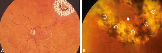 Photocoagulation préventive par laser autour de lésions rétiniennes à risque de décollement.