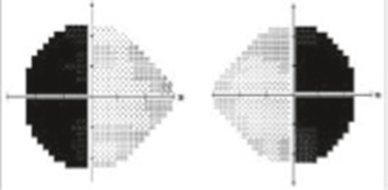 Champ visuel automatisé montrant une hémianopsie bitemporale avec perte nette des champs latéraux dans les deux yeux.