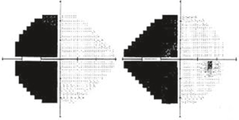 Champ visuel montrant une hémianopsie homonyme gauche complète, évocatrice d’une lésion rétrochiasmatique droite.