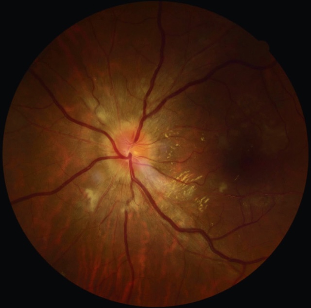 Œdème papillaire volumineux avec exsudats péripapillaires, signe d’une atteinte rétinienne hypertensive sévère.