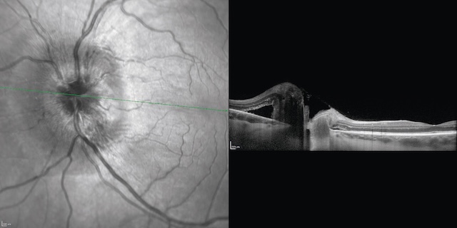 Fond d’œil gauche et OCT montrant une traction vitréomaculaire avec soulèvement fovéal. Distorsion rétinienne centrale évocatrice d’un syndrome tractionnel.