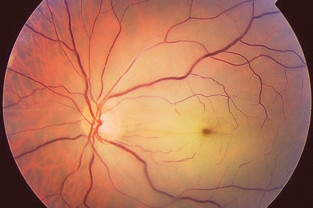 Fond d’œil normal montrant une papille nette, des vaisseaux réguliers et une macula intacte.