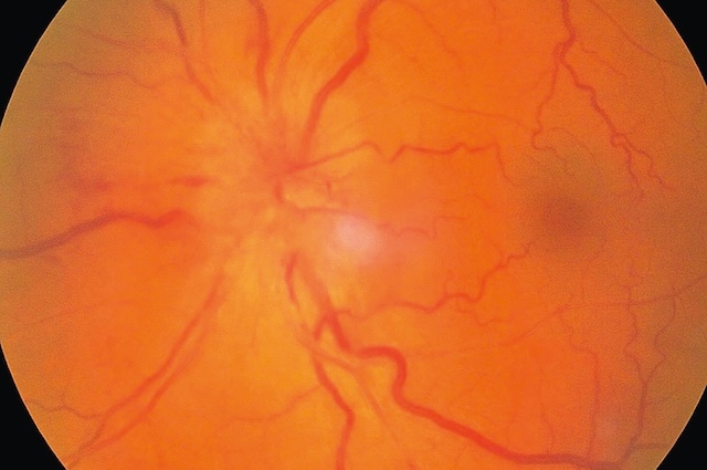 Fond d’œil montrant un œdème papillaire avec bords flous et hyperhémie diffuse du disque optique, associé à une congestion vasculaire.