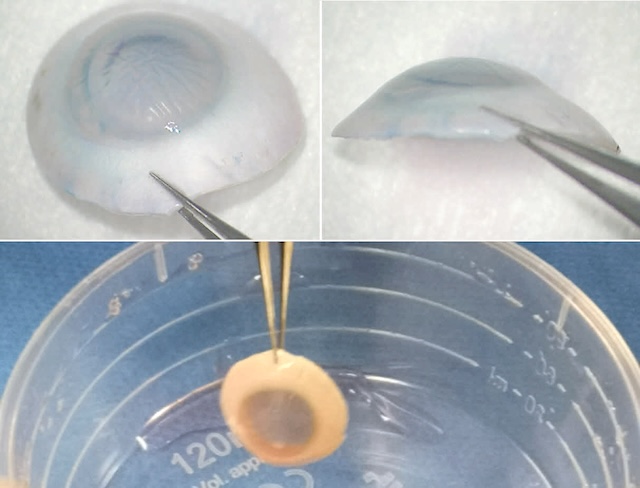 Greffon cornéen bombé et translucide manipulé avec pince, puis suspendu dans un liquide de conservation en vue d’une transplantation.