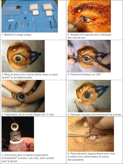 Préparation, trépanation, prélèvement de cornée, mise en conservation et reconstruction palpébrale finale avec conformateur et suture.