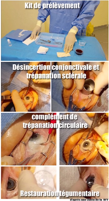 Déroulement d’un prélèvement cornéen chirurgical, de la désinsertion conjonctivale à la restauration finale avec conformateur oculaire.