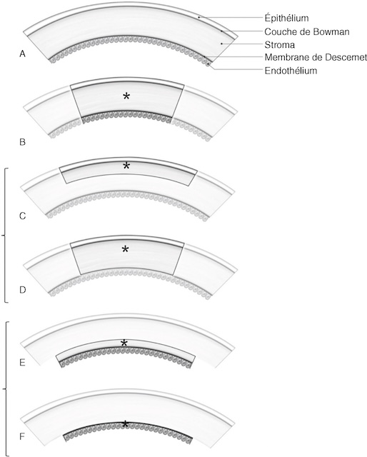 Schémas des différentes greffes cornéennes selon la profondeur : lamellaires antérieures (B-D) et postérieures (E-F), adaptées aux lésions ciblées.