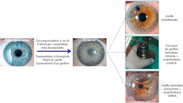 Photographies de complications cornéennes traitées par greffes : transfixiante, DSAEK (stroma-endothélium) et DMEK (Descemet-endothélium).